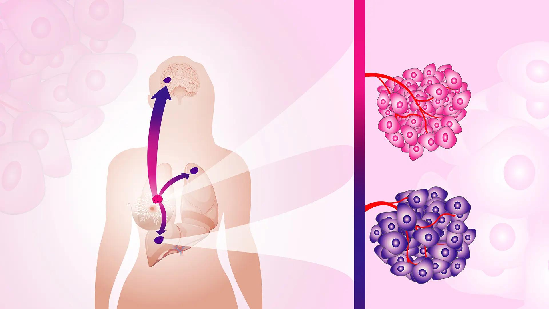 Illustration av cancercellers spridning i kroppen
